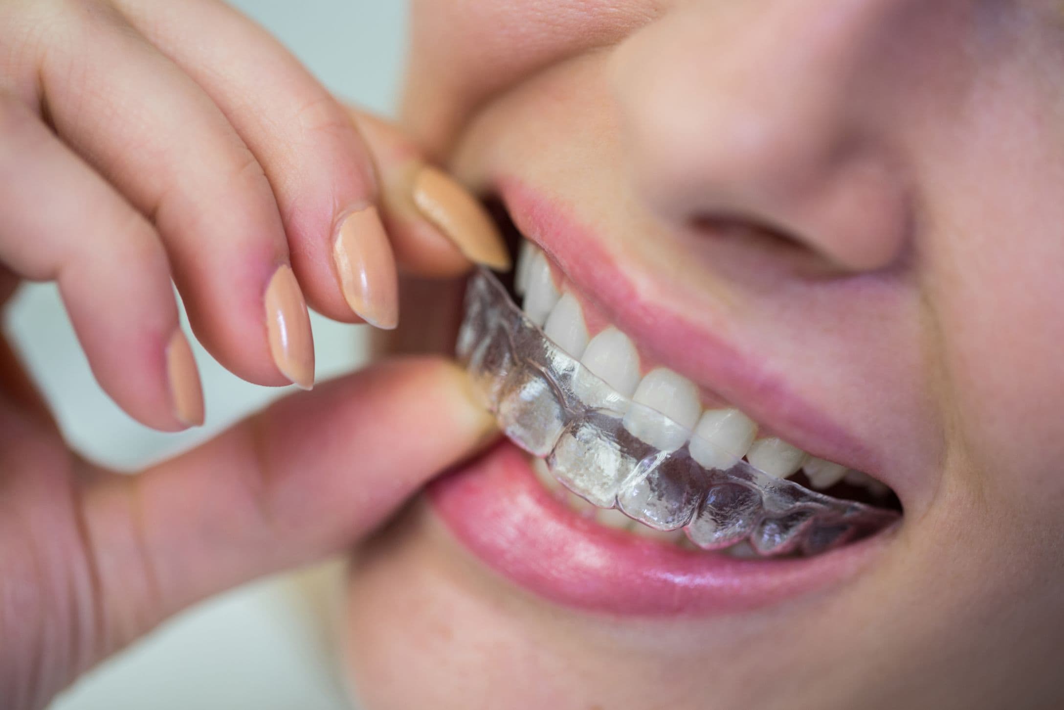 Invisalign in West Mobile